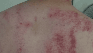 Image for Gua Sha Therapy (aka - Scraping)